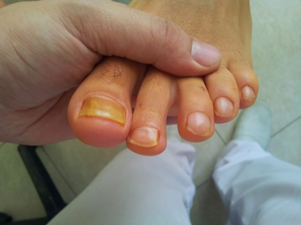 yellowing sa mga toenails uban sa fungus